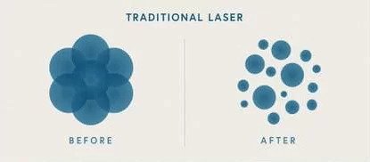 traditional-laser-min