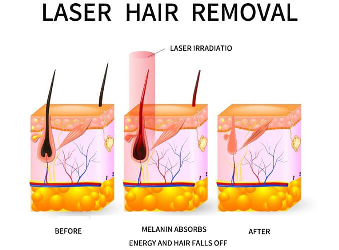 808nm diode laser hair removal machine 808nm diode laser hair removal machine