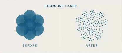 picosure-laser-min
