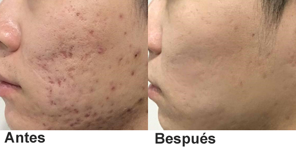 tattoo removal laser