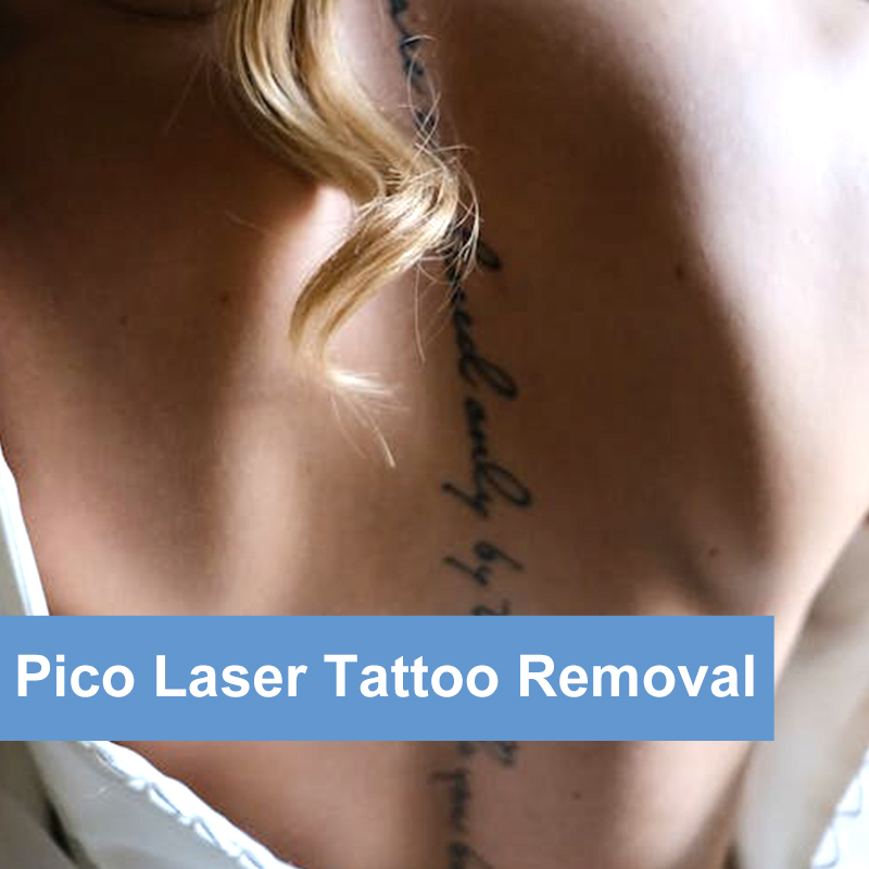 Laser Tattoo Removal