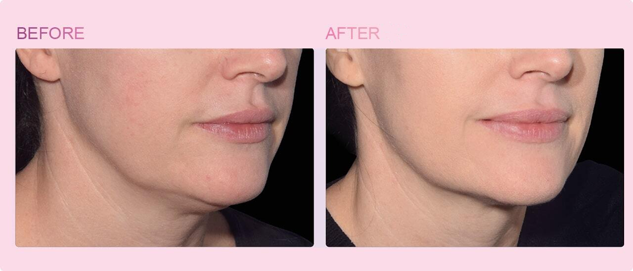 before-after-emface-treatment-in-denver