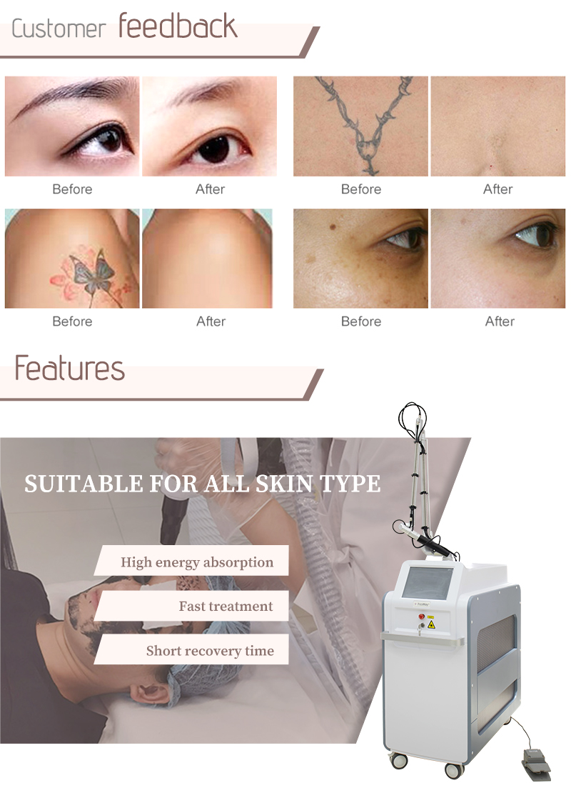 picoway lsaer tattoo removal machine