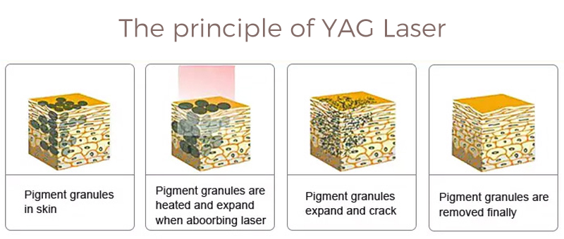 nd yag laser machine