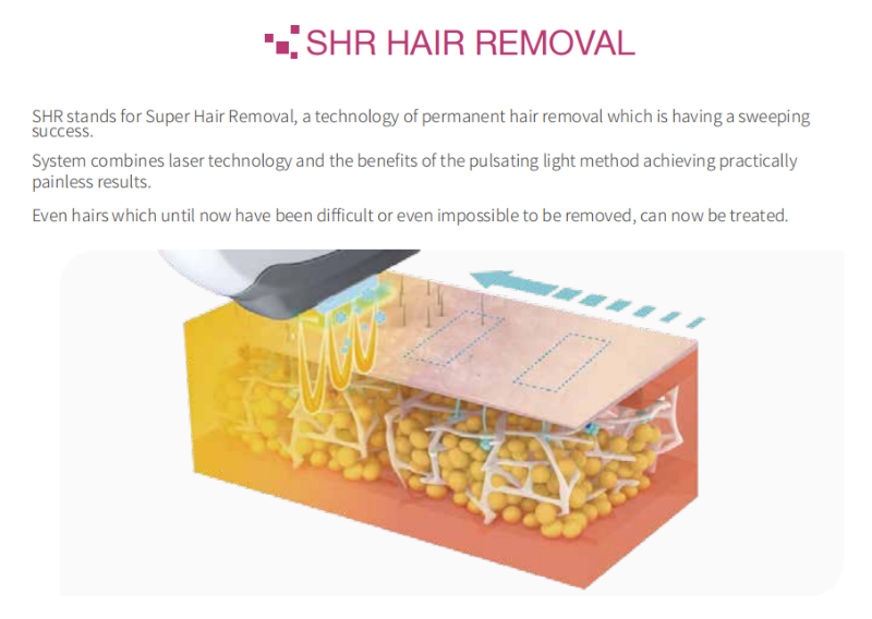 SHR hair removal