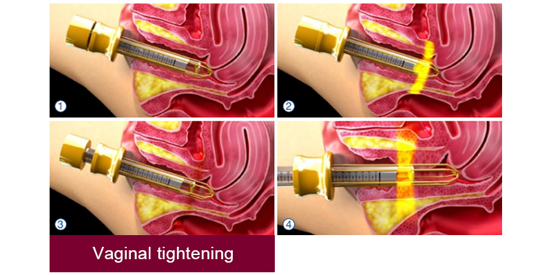vaginal tightening