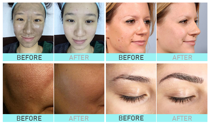 nd yag laser tattoo removal machine