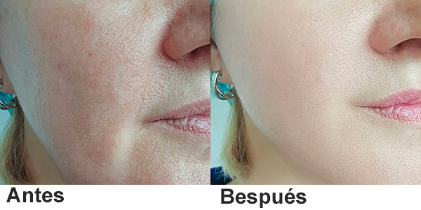 laser tattoo removal machine