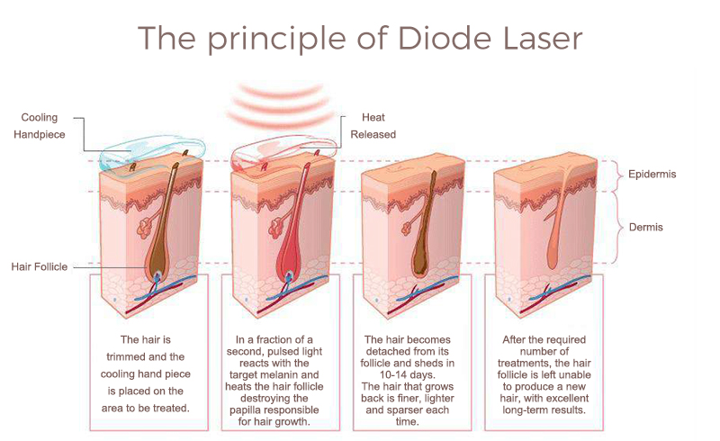 diode laser hair removal