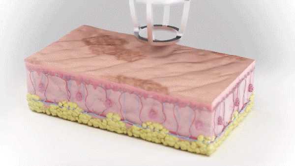 fractional co2 laser cost