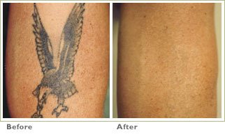 tattooremoval