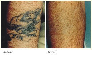 tattooremoval