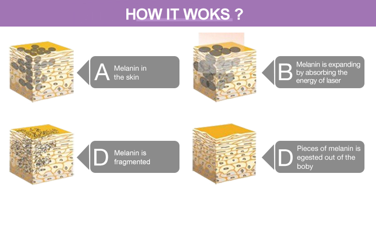 tattoo removal machine