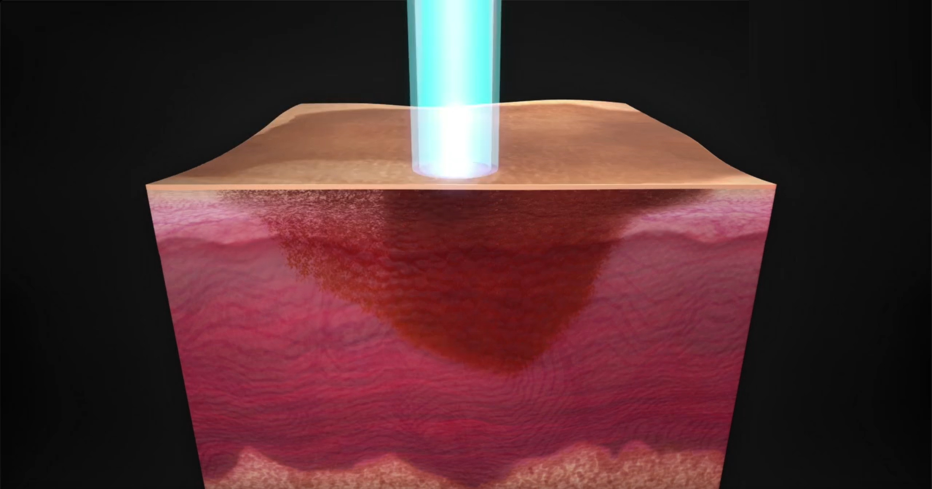 nd yag laser tattoo removal machine