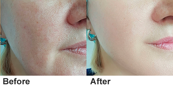 best nd yag laser machine