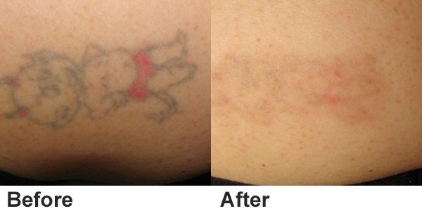 ND Yag Laser Functions