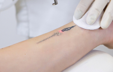 laser tattoo removal