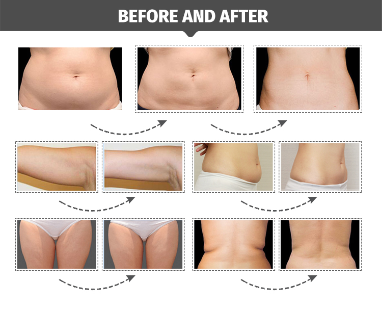 sculpsure procedure