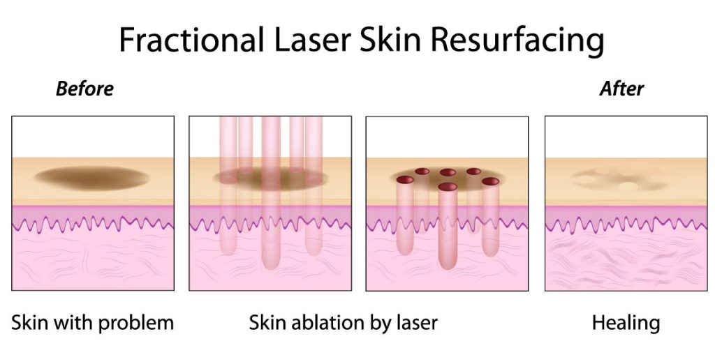 facial laser resurfacing