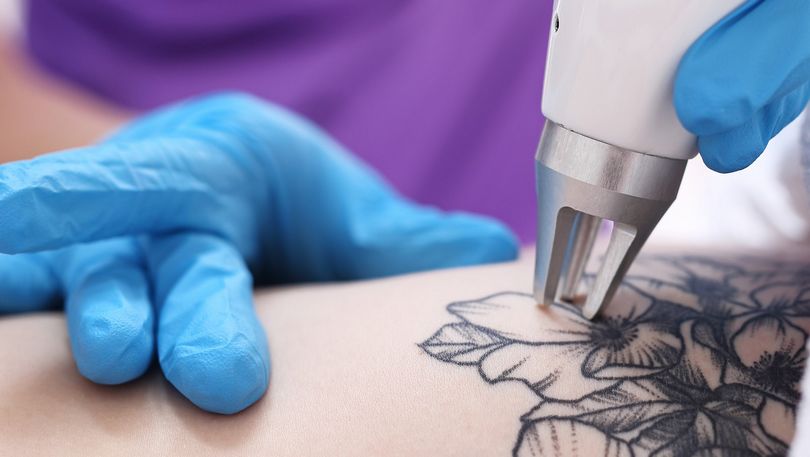 Picosecond Laser Tattoo Removal