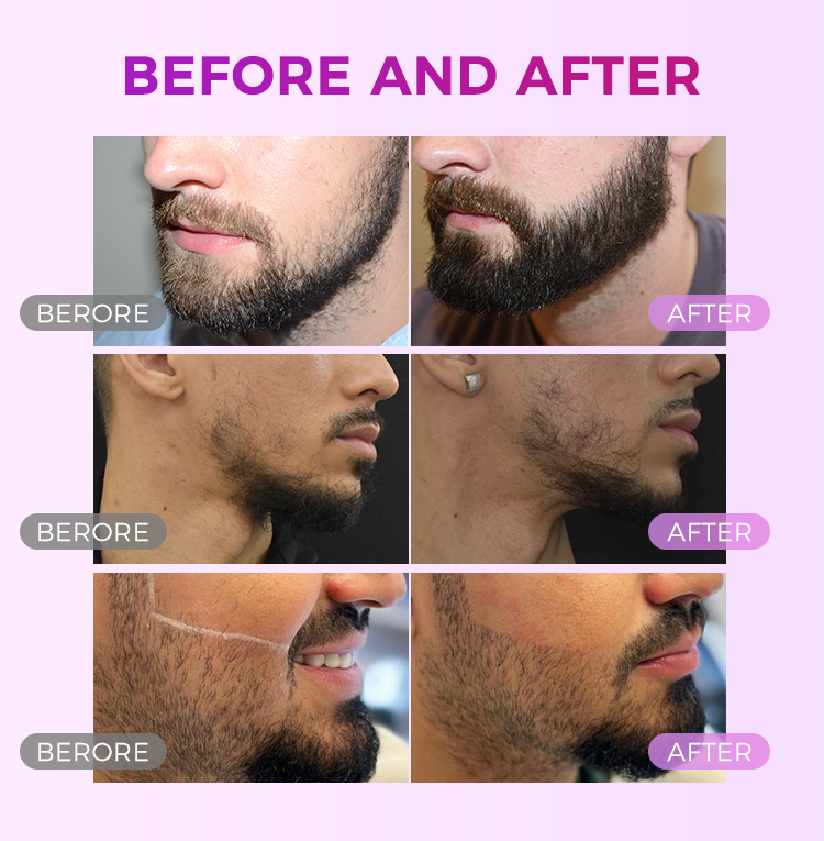 facial hair laser removal for men