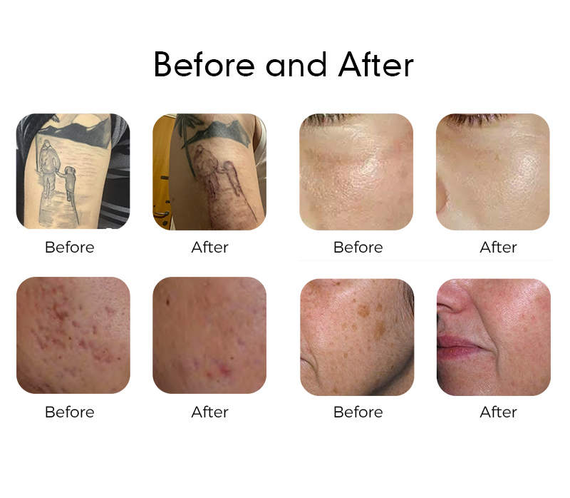 Nano & Pico Laser for Professional Use Dual Pulse Mode 532nm 1064nm 350ps PlCO +2ns Nano