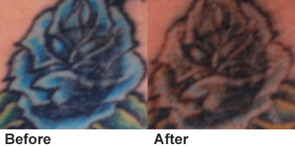 ND Yag Laser Functions