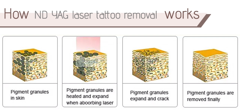 q switched nd yag laser tattoo removal