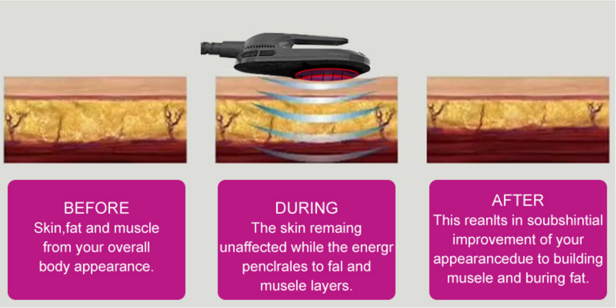 fat reduction and shape