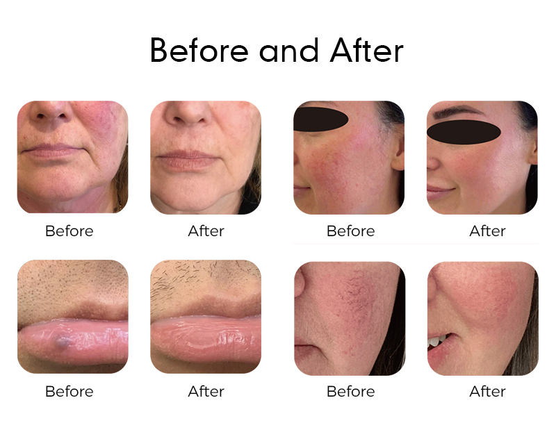 980 Physiotherapy Instrument for High-Intensity Therapy And Pain Relief with Diode Laser