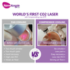 Portable Fractional CO2 Laser Machine Effective Freckle Removal