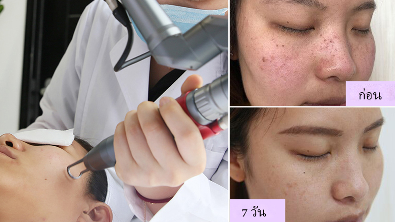 laser tattoo removal machine