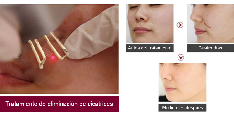 co2 laser for acne scars
