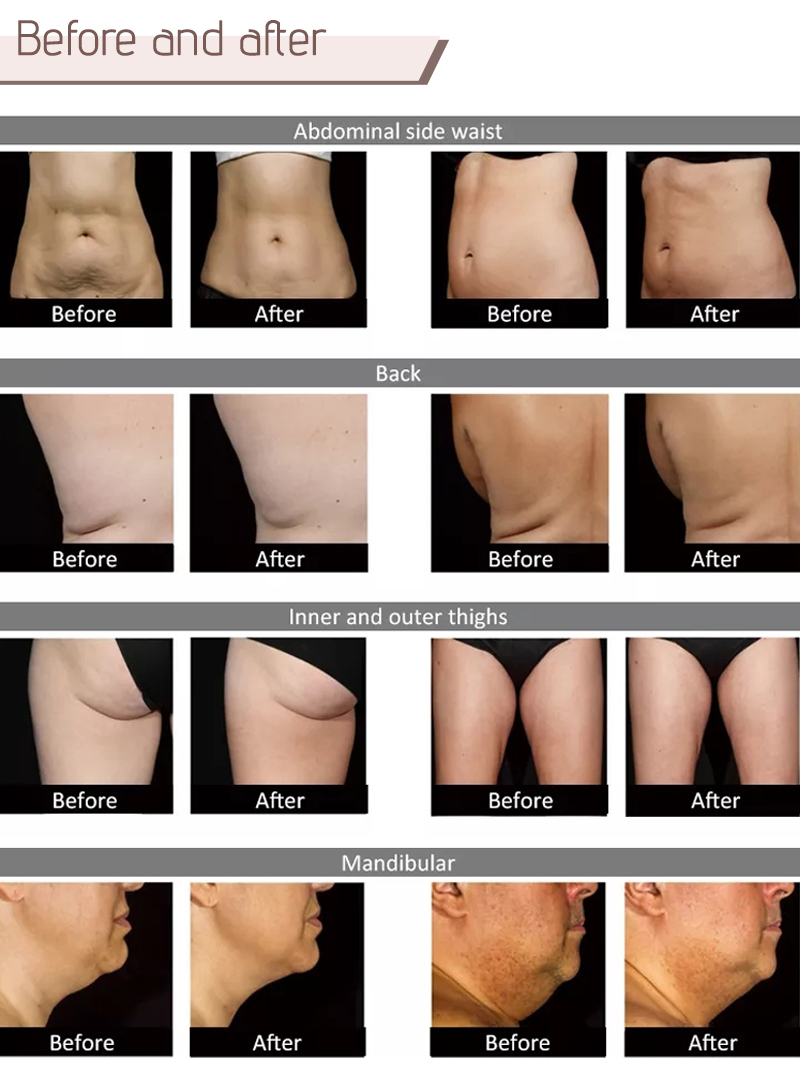 diode laser slimming machine