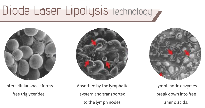diode laser lipolysis