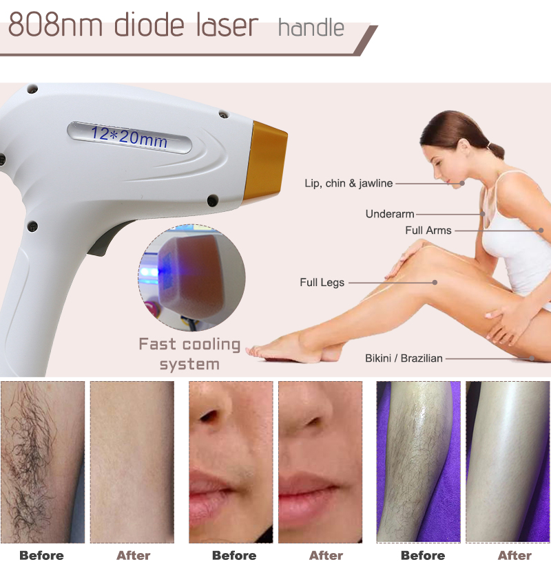 ingrown hair removal
