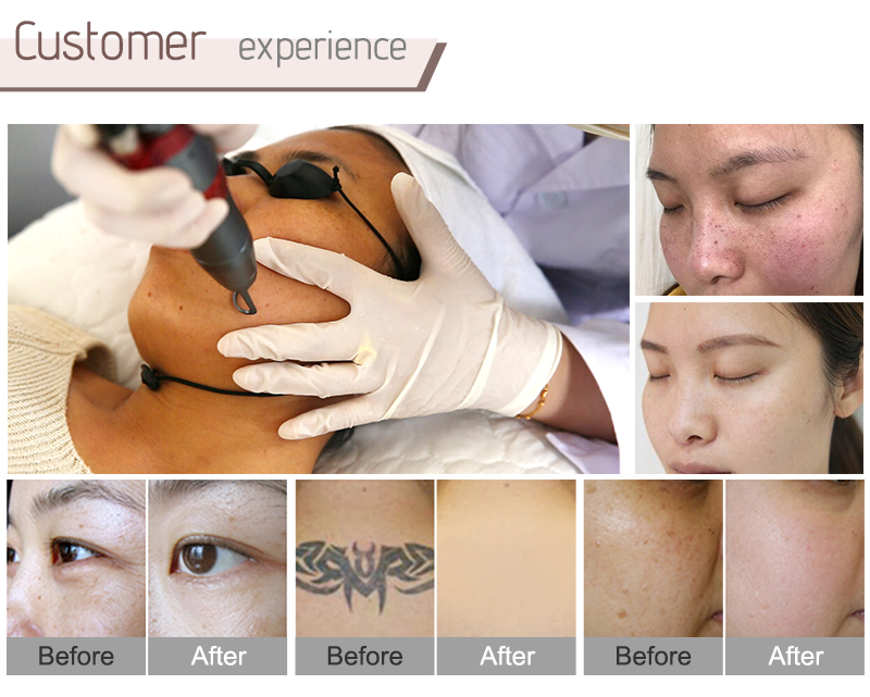 picosecond laser tattoo removal machine