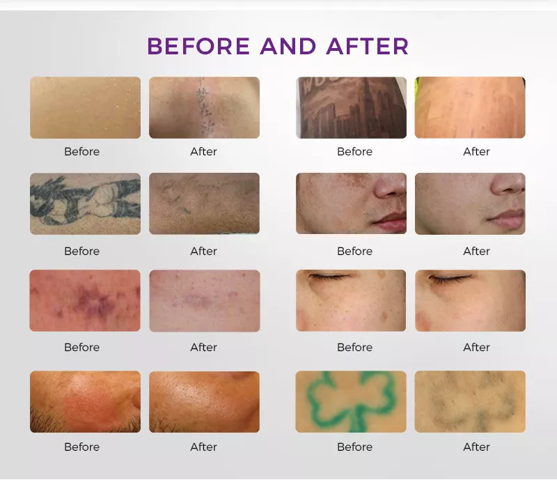 Before and after picosecond laser treatment