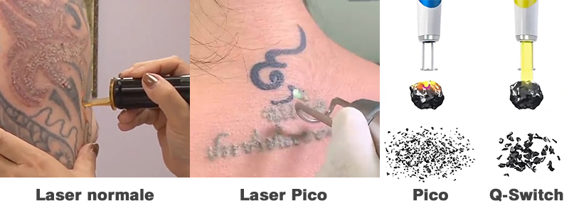 pico laser tattoo removal