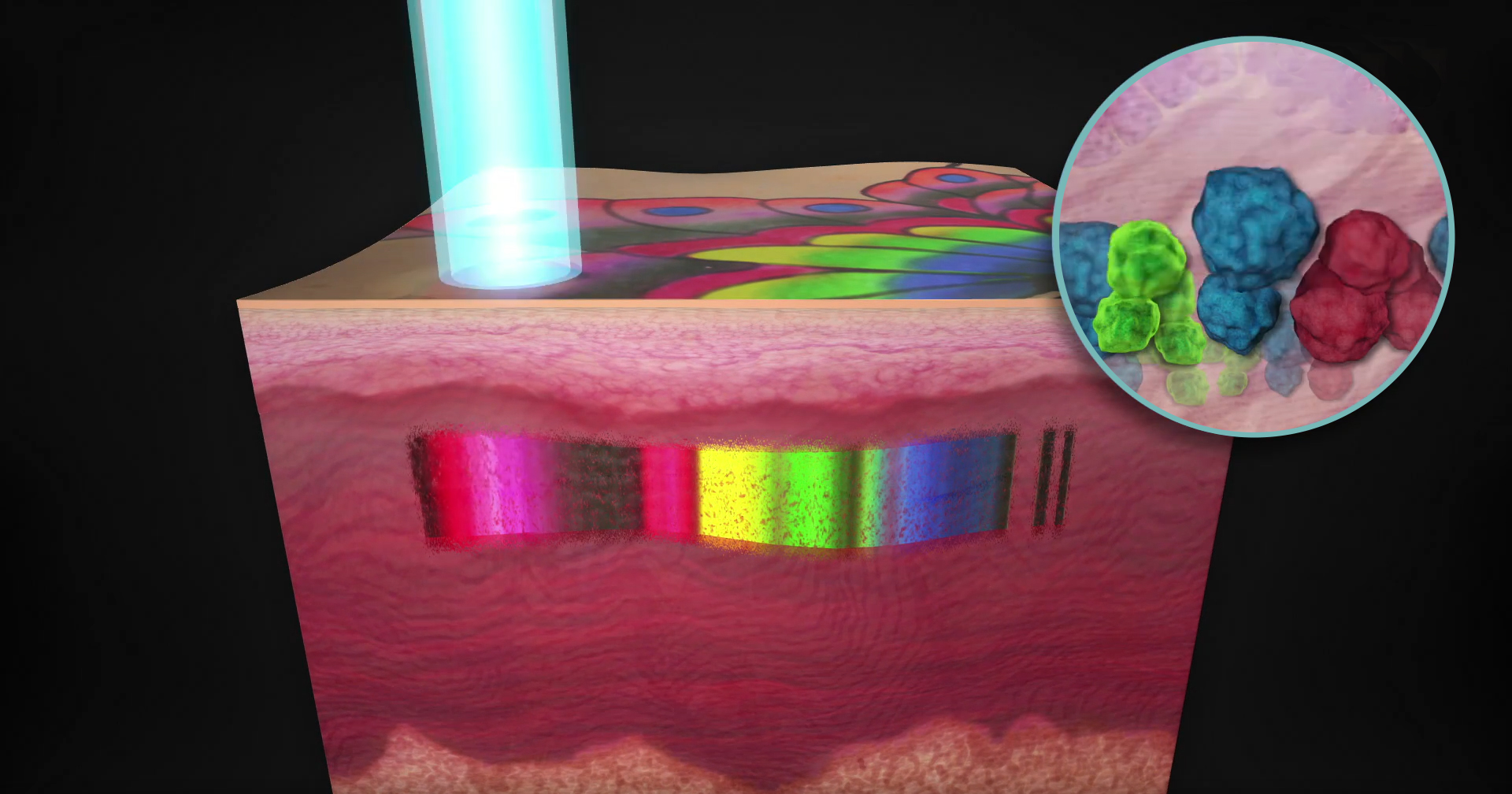 laser tattoo removal machine