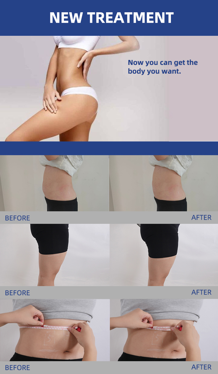 trusculpt id before and after