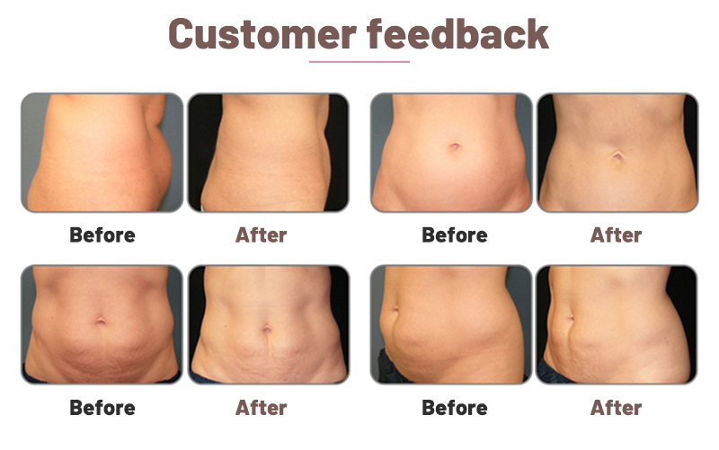 laser therapy for weight loss