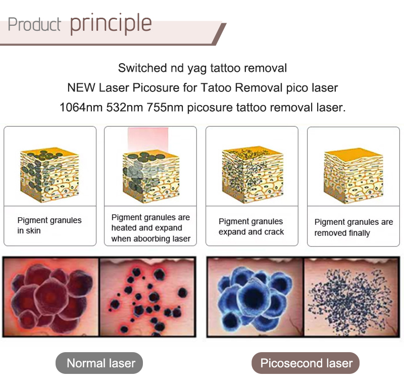 pico laser tattoo removal