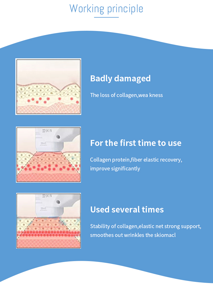 portable hifu machine