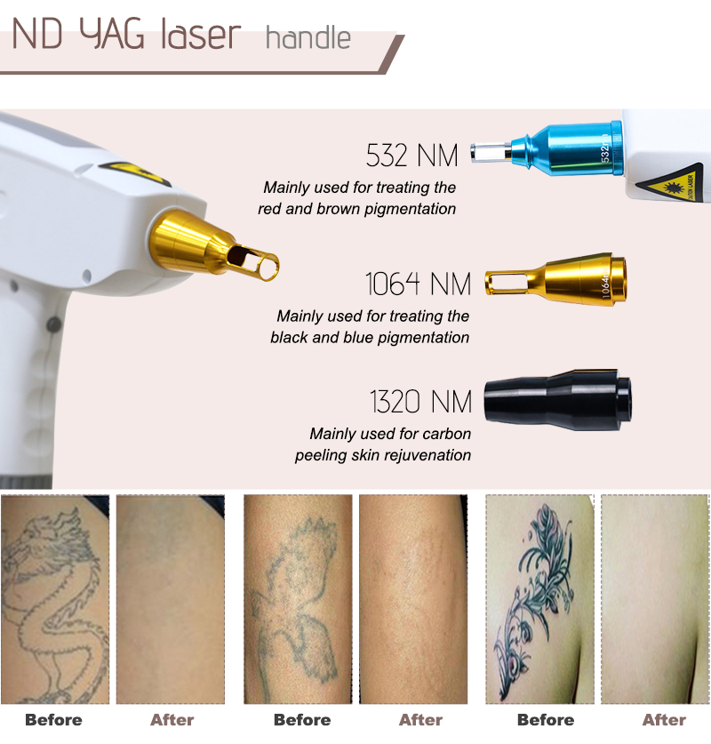 nd yag laser tattoo removal
