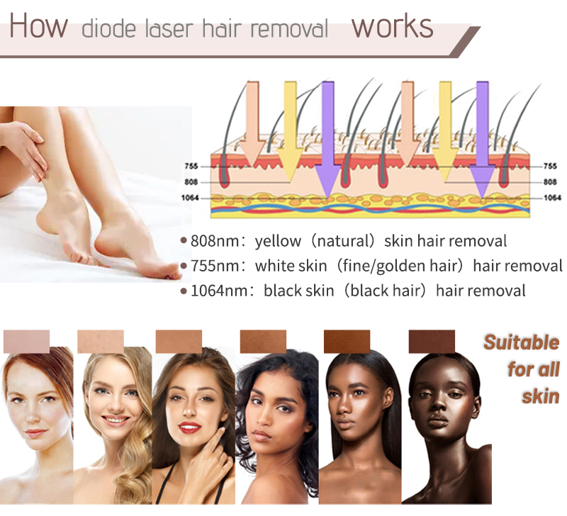 laser hair removal prices
