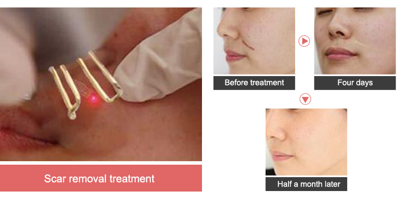 co2 laser for acne scars