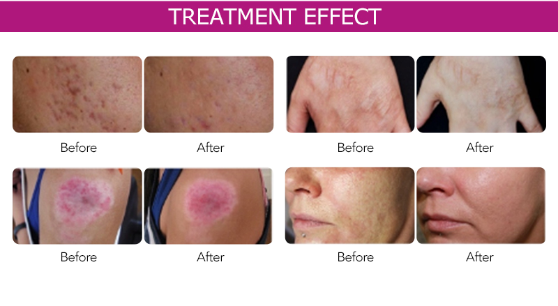 Fractional RF Microneedle