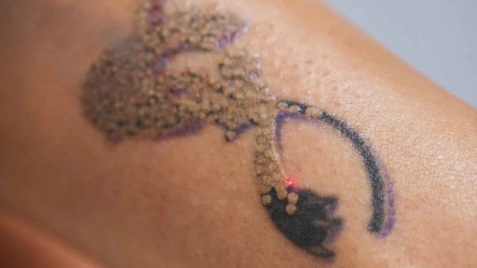 Top Tattoo Removal Machine Suppliers And Laser Equipment for Professionals