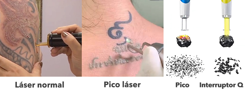 pico laser tattoo removal